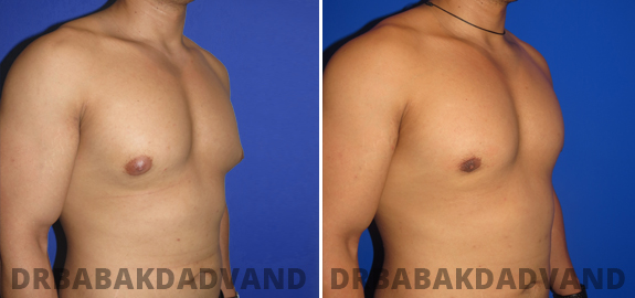 Before and After Photos. Gynecomastia. 5